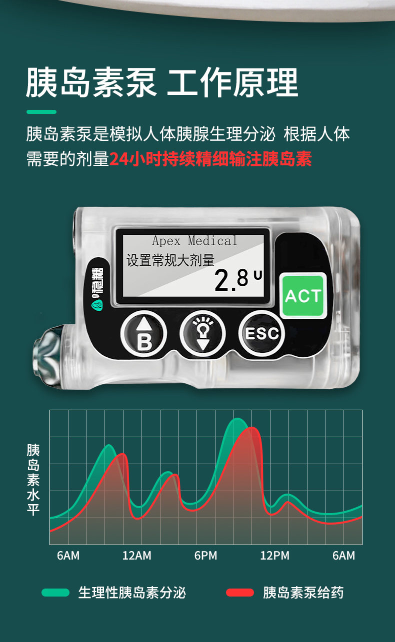 最新全自動胰島素泵，糖尿病管理的革命性進(jìn)步，全自動胰島素泵，糖尿病管理的突破性革新