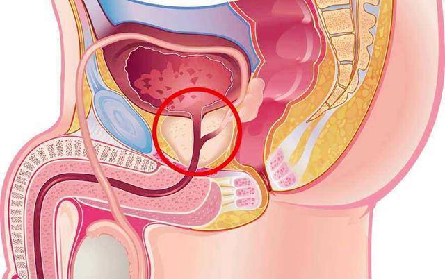 男性前列腺肥大，了解、識別與應(yīng)對，男性前列腺肥大，全面解析與應(yīng)對之道