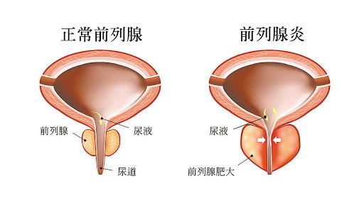 關(guān)于前列腺與性功能的關(guān)系，探究?jī)烧咧g的關(guān)聯(lián)與影響，前列腺與性功能關(guān)系探究，關(guān)聯(lián)與影響分析