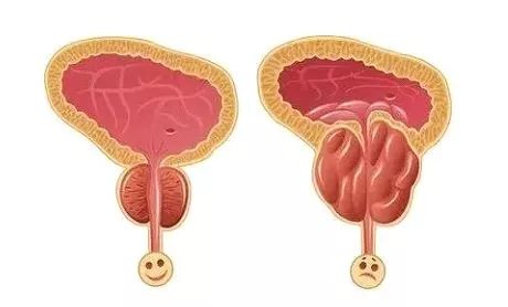 老公的前列腺增大挑戰(zhàn)，理解、支持與共同對(duì)抗，老公前列腺增大，理解、支持與共同應(yīng)對(duì)的挑戰(zhàn)