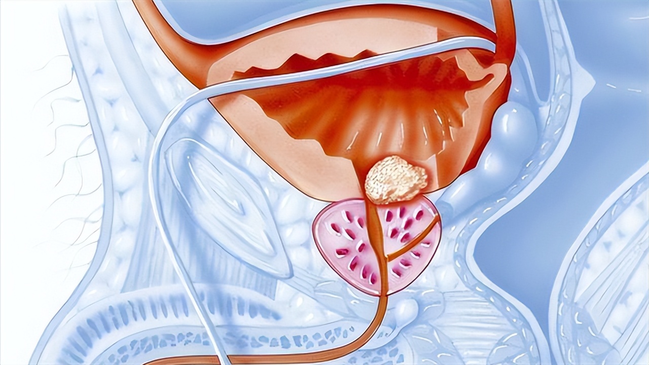 如何判斷是否得了前列腺問(wèn)題，如何判斷前列腺問(wèn)題？常見(jiàn)癥狀及檢查方法解析