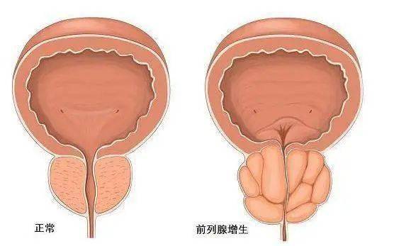 前列腺鈣化，一種常見(jiàn)的前列腺疾病及其相關(guān)知識(shí)解析，前列腺鈣化解析，常見(jiàn)疾病與相關(guān)知識(shí)探討