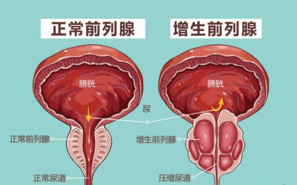 前列腺增生大小標(biāo)準(zhǔn)，理解其關(guān)鍵要素與影響，前列腺增生大小標(biāo)準(zhǔn)詳解，關(guān)鍵要素與影響因素解析