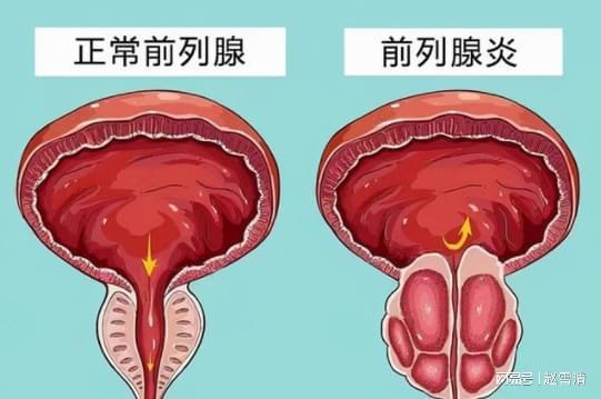 男性前列腺炎的癥狀解析，男性前列腺炎的癥狀詳解