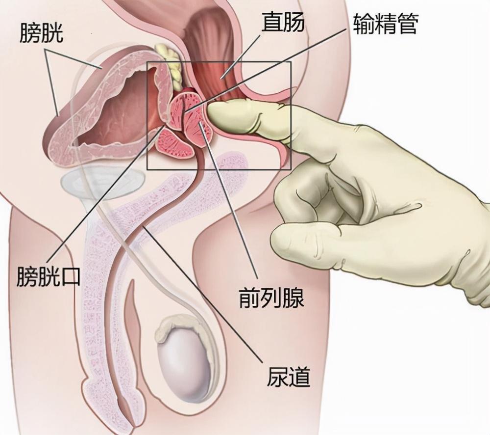 前列腺炎，重新認識男性健康的誤區(qū)，重新認識男性健康誤區(qū)，前列腺炎解析