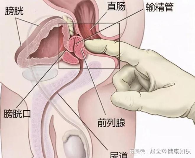 慢性前列腺炎，能否徹底治愈？解析與探討，慢性前列腺炎的治愈可能性解析與探討