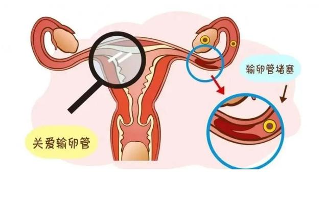 輸卵管堵塞的癥狀表現(xiàn)與解析，輸卵管堵塞的癥狀、表現(xiàn)與解析