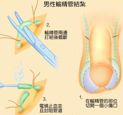 為什么醫(yī)院不提倡男性結(jié)扎，探究背后的原因與考量，探究醫(yī)院不提倡男性結(jié)扎的背后原因與考量