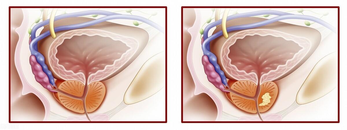 前列腺鈣化，揭示其潛在危害，前列腺鈣化，潛在危害揭秘