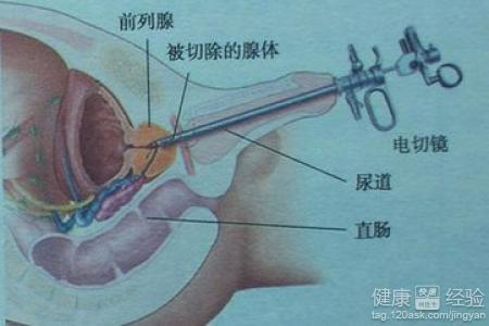 如何控制前列腺增生，如何控制前列腺增生的發(fā)展及癥狀？