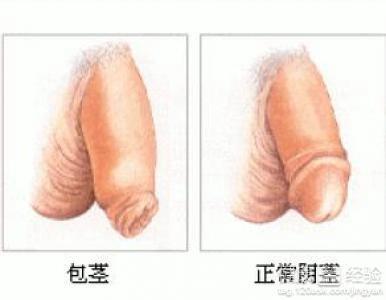 包莖過(guò)長(zhǎng)對(duì)身體的影響及應(yīng)對(duì)措施，包莖過(guò)長(zhǎng)對(duì)身體的影響與應(yīng)對(duì)措施解析