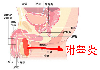 附睪炎，絕望中的希望曙光，附睪炎，絕望中的希望之光